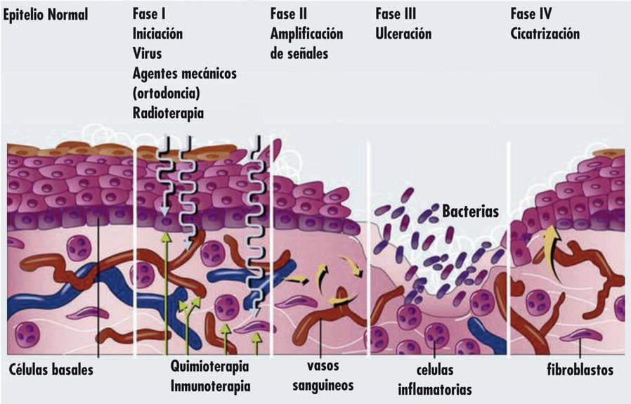 Fases de la mucositis